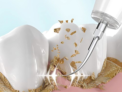 SKALER DENTYSTYCZNY ULTRADŹWIĘKOWY DO CZYSZCZENIA ZĘBÓW USUWANIE KAMIENIA
