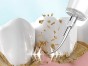 SKALER DENTYSTYCZNY ULTRADŹWIĘKOWY DO CZYSZCZENIA ZĘBÓW USUWANIE KAMIENIA
